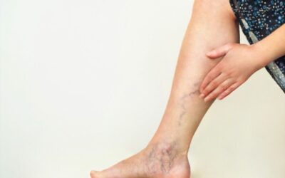 أهم 5 أسباب دوالي الساقين وكيف يمكن علاجها مع دكتور وليد الدالي