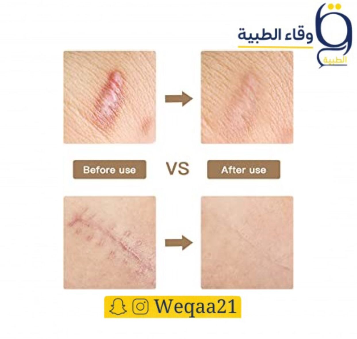 إليك كيفية اختيار أفضل لصقات السيليكون بعد العمليات الجراحية