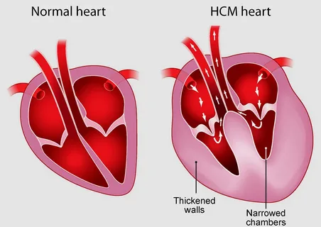 كل ما تحتاج معرفته عن ارتجاع الصمام الأورطي: الأسباب، الأعراض، وطرق العلاج الحديثة